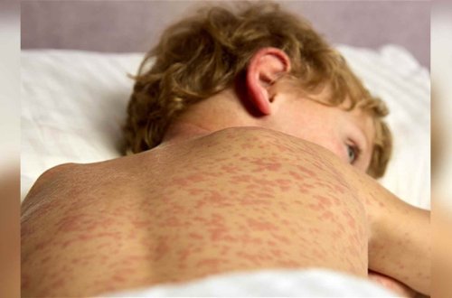 Ermənistanda son bir həftə ərzində daha 8 nəfər qızılcaya yoluxub