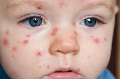 SN qızılca peyvəndi ilə bağlı valideynlərə xəbərdarlıq etdi