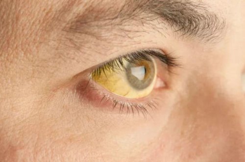 Sarılıq xəstəliyindən necə qorunmalı? - VİDEO