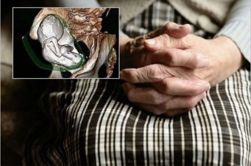 Ölü körpəsini 35 il bətnində gəzdirən qadın həkimləri şoka saldı - FOTO