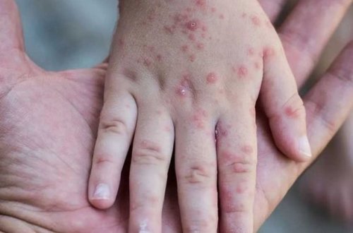 ÜST Avropada qızılca epidemiyasının səbəbini açıqladı