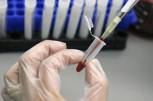 SN: Bu şəxslər Hepatit A virusuna daha çox yoluxur