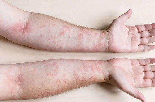 Bu bölgəmizdə qızılcaya yoluxma sayında yenidən artdı