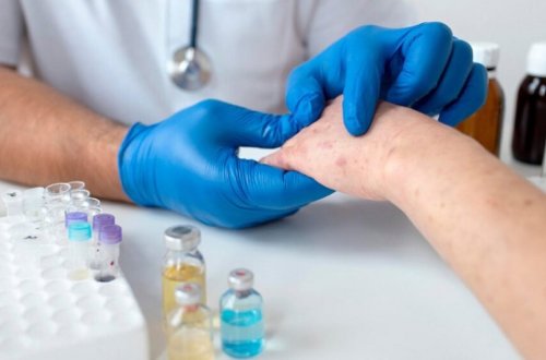 İnfeksionist qızılcaya xas olan əlamətləri açıqlayıb