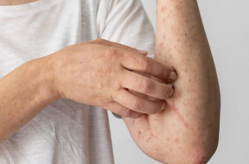 ​​​​​​​Ermənistanda qızılcaya yoluxma hallarının sayı kəskin artıb