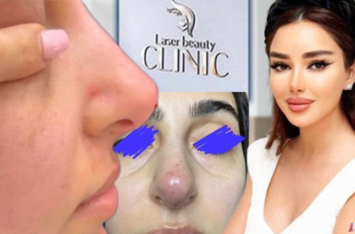 Kosmetoloq Rəna Soltanova vətəndaşın burnun şikəst edib - “Laser Beauty Clinic” QƏSSABXANA kimi işləyir (VİDEO)
