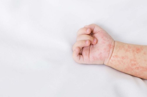 Ötən gün ölkə üzrə qızılcaya yoluxma ilə bağlı 29 hadisə qeydə alınıb