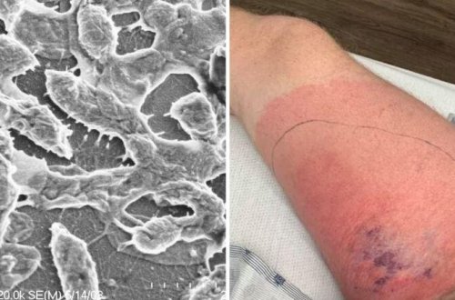 Bu ölkədə ət yeyən bakteriyalar insanları iki gündə öldürür