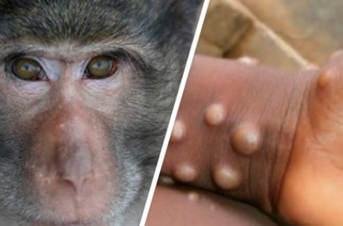 ÜST meymunçiçəyi xəstəliyinə yoluxanların sayını AÇIQLADI