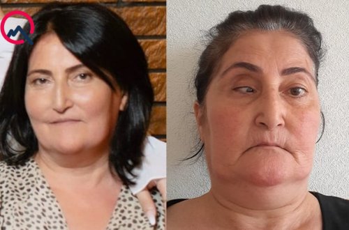 Burun əməliyyatına girən qadının gözündə çəplik yarandı - FOTO