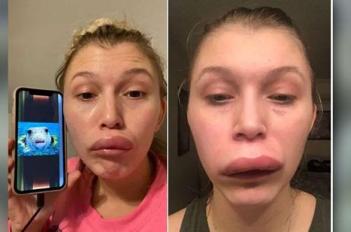 İnsanı şar balığına çevirən nadir xəstəlik 36 yaşlı qadında 11 il sonra ÜZƏ ÇIXDI - FOTO