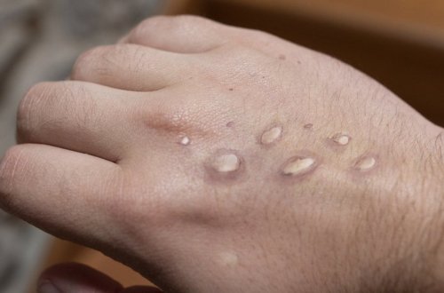 Avstraliyada meymunçiçəyinə yoluxma halları kəskin artıb