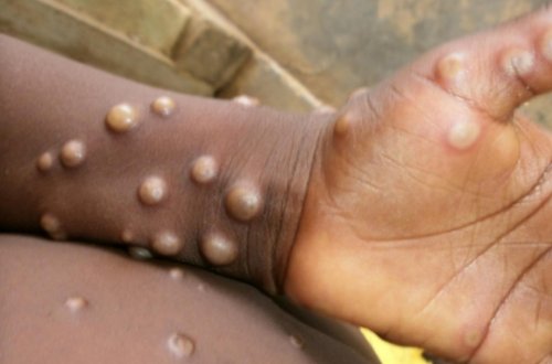 Bu ölkədə meymunçiçəyinə yoluxma səngimək bilmir - 570 nəfər virusdan ölüb