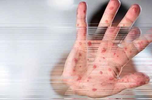 Argentinada yük gəmisi meymun çiçəyi virusu ilə bağlı karantinə alındı