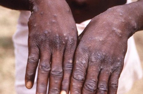 Konqoda mindən çox insan meymunçiçəyinə yoluxdu