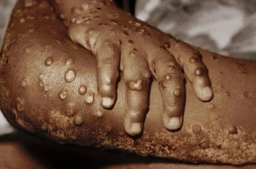 Filippində meymun çiçəyinə yoluxma sayı 3-ə çatıb