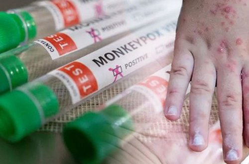 Afrikada həftə ərzində meymunçiçəyinə minlərlə insan yoluxub