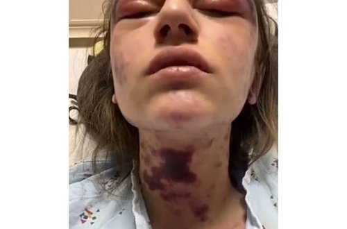 23 yaşlı gənc qadın peyvənd olunduqdan 10 dəqiqə sonra kor olub