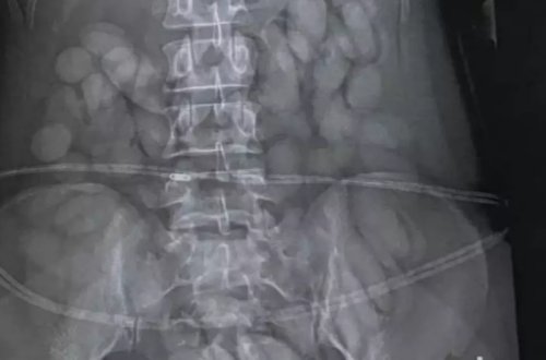 Hava limanında mədəsində narkotik həb keçirmək istəyən qadın həbs edildi