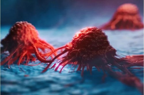 Döş xərçəngi 50 yaşdan aşağı insanlarda artıb: Ölüm nisbəti irqə görə dəyişir! 