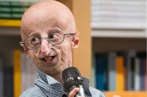 Benjamin Button xəstəliyinin simvolu oldu: 28 yaşında öldü 