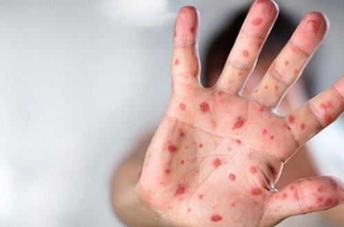 Meymunçiəyi virusu tüğyan edir - Daha iki ölkədə təsbit edildi