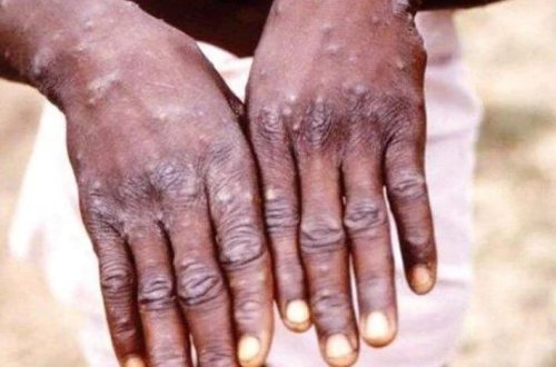 Afrikada meymun çiçəyindən ölənlərin sayı 1100-ə yüksəldi