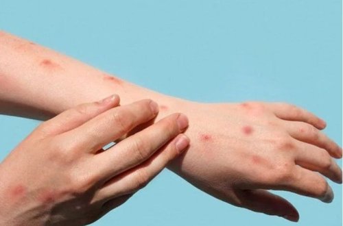 Almaniyada meymunçiçəyi virusunun yeni variantı ortaya çıxıb