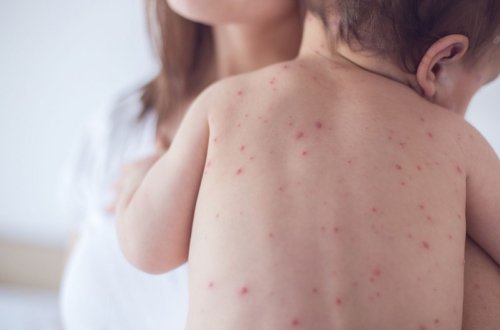 Bu ilin ilk doqquz ayında suçiçəyi xəstəliyinə yoluxma səviyyəsi iki dəfə azalıb