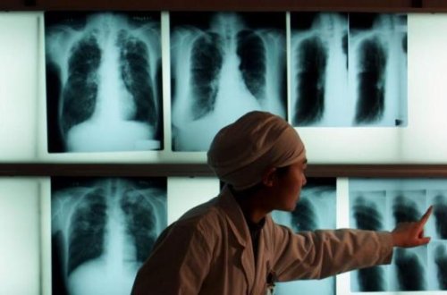 Vərəm yenidən ən ölümcül yoluxucu xəstəlik oldu