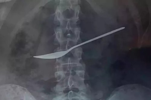 Qarın ağrısı ilə xəstəxanaya aparılan qadının mədəsindən görün nə çıxarıldı