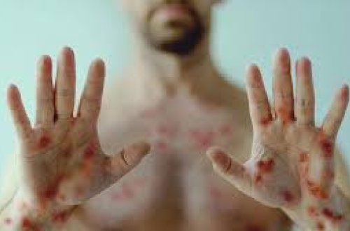 ABŞ-də meymunçiçəyinin yeni ştamına ilk yoluxma halı qeydə alınıb