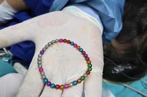 5 yaşlı uşağın bağırsağından 38 maqnit çıxarıldı