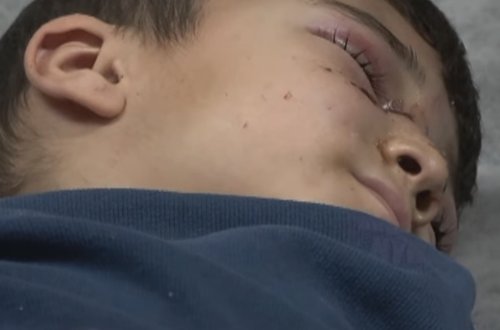 Türkiyədə sahibsiz itlər 7 yaşlı uşağa hücum etdi