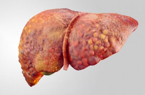 Qaraciyərin piylənməsi xərçəng xəstəliyinə necə səbəb olur - ARAŞDIRMA