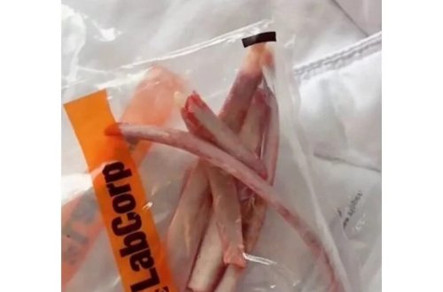 İncəlmək üçün 6 qabırğasını çıxartdı: Onu dostuma hədiyyə edəcəm 