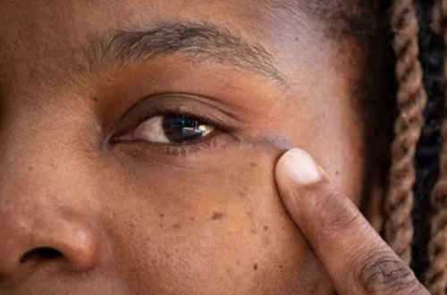 Tibbdə ilk: Böyük Britaniyada göz yuvasından şiş çıxarılıb