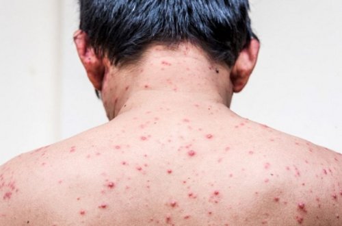 Nazirlik: Meymunçiçəyi virusuna qarşı antibiotiklərdən istifadə olunmamalıdır