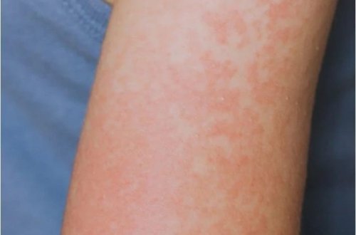 Qızılcaya yoluxma halları artır: Texasda 48 hadisə aşkarlanıb