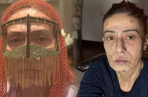 Yıldız Tilbe yanıq izlərini maska ilə gizlətdi - FOTOLAR