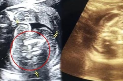 Hindistanda qeyri-adi olay: Yeni doğulan körpədən 2 döl çıxdı