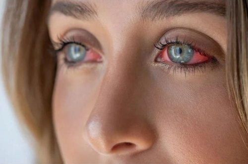 53 yaşlı qadın qəfildən kor oldu: 20 ildir kontakt linzalardan istifadə edirdi