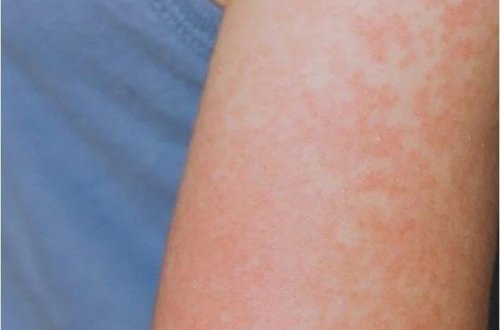 Peyvənd olunmamış uşaq qızılcadan öldü