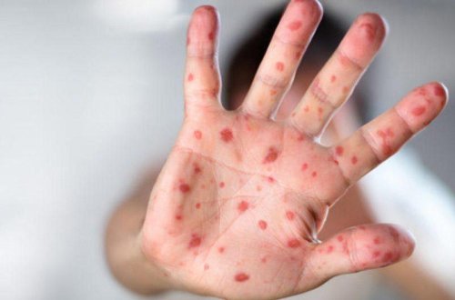 ABŞ-də 12 ştatda qızılca tüğyan edir