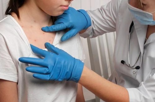 Qızılca geri döndü: Ümumdünya Səhiyyə Təşkilatından oyanış çağırışı