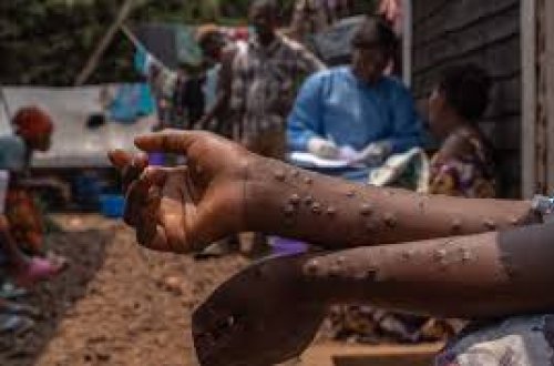 Uqandada meymunçiçəyinə yoluxma 5 minə çatır, ölənlər var