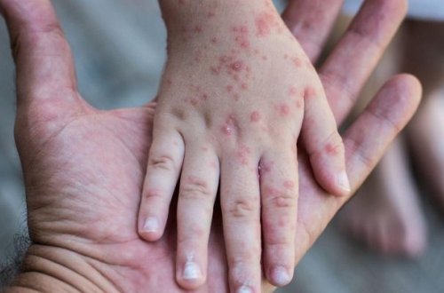 Azərbaycanda suçiçəyi və qızılcaya yoluxma ilə bağlı son vəziyyət AÇIQLANDI