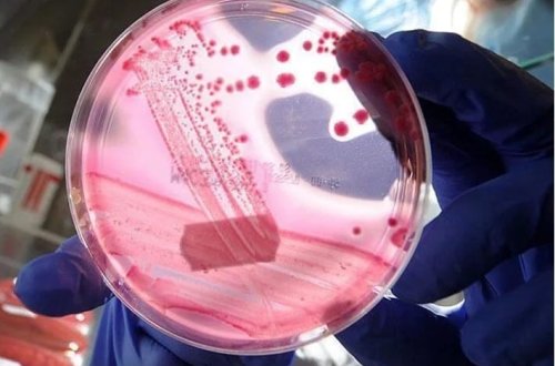 Prostat xərçəngində yeni diaqnoz tüpürcək vasitəsilə aşkar edilir