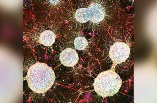 Şizofreniya xəstələrinin beyinləri sağlam insanlara nisbətən daha tez qocalır