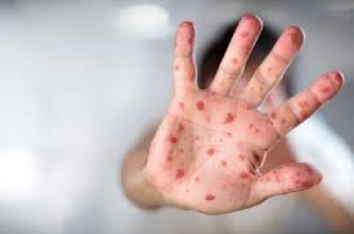 Monqolustanda qızılca epidemiyası: Minlərlə yoluxma, ilk ölüm halı